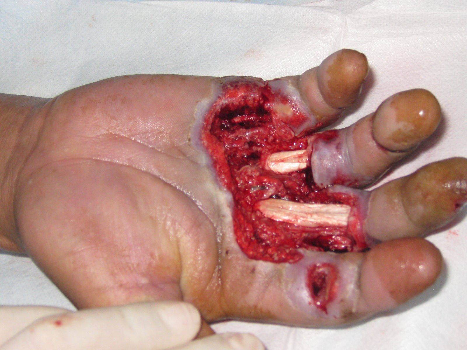 彻底清创是创面顺利愈合的法宝2