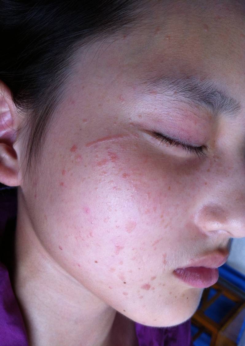 艾拉-光动力治疗扁平疣照片展示 - 好大夫在线