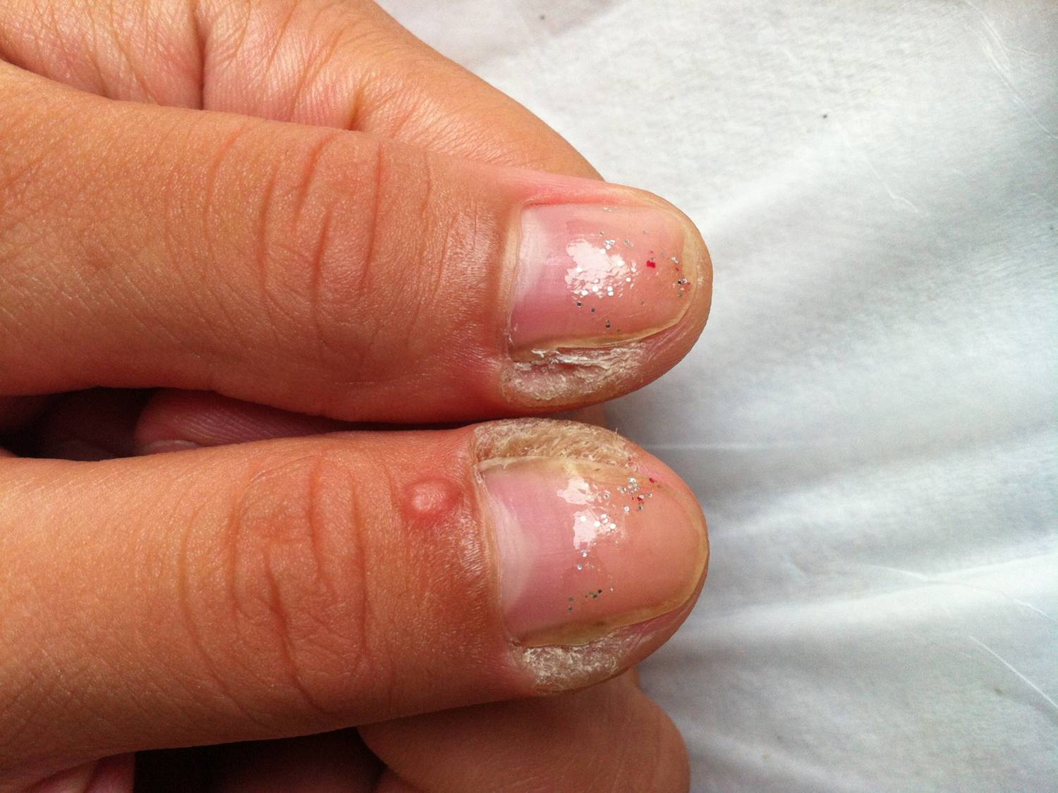 艾拉光动力治疗甲下疣照片展示 - 好大夫在线