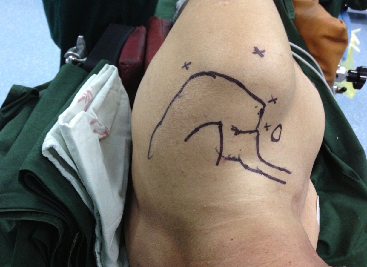 肩关节镜微创肩峰成形手术治疗肩峰撞击综合征