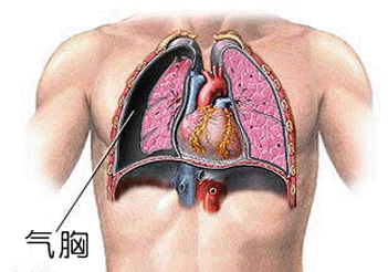 什么是肺大泡?它是怎样引起自发性气胸的?