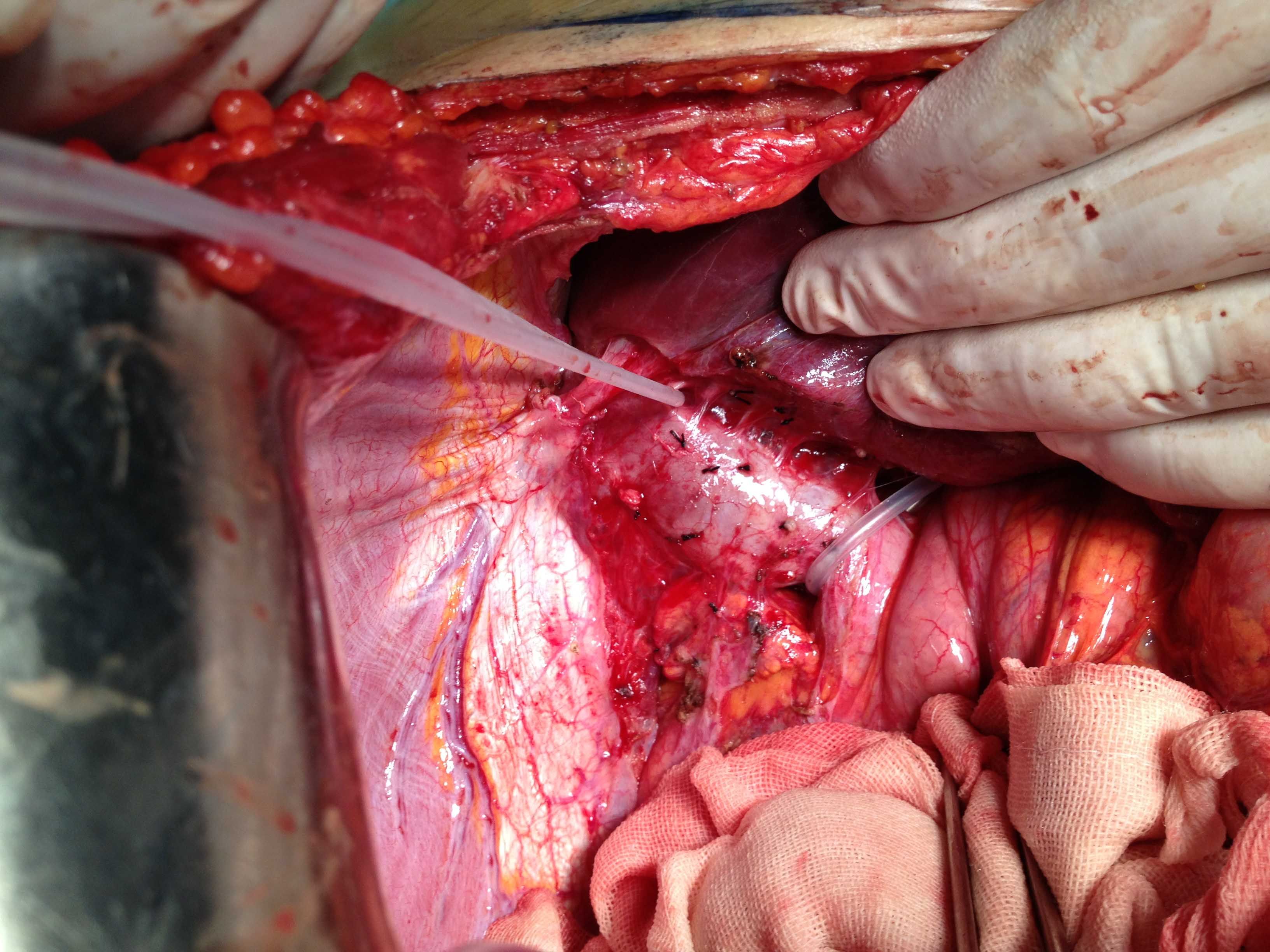 卿氏手术风采之二——右半肝切除之肝右静脉,肝短静脉,肝后隧道,右