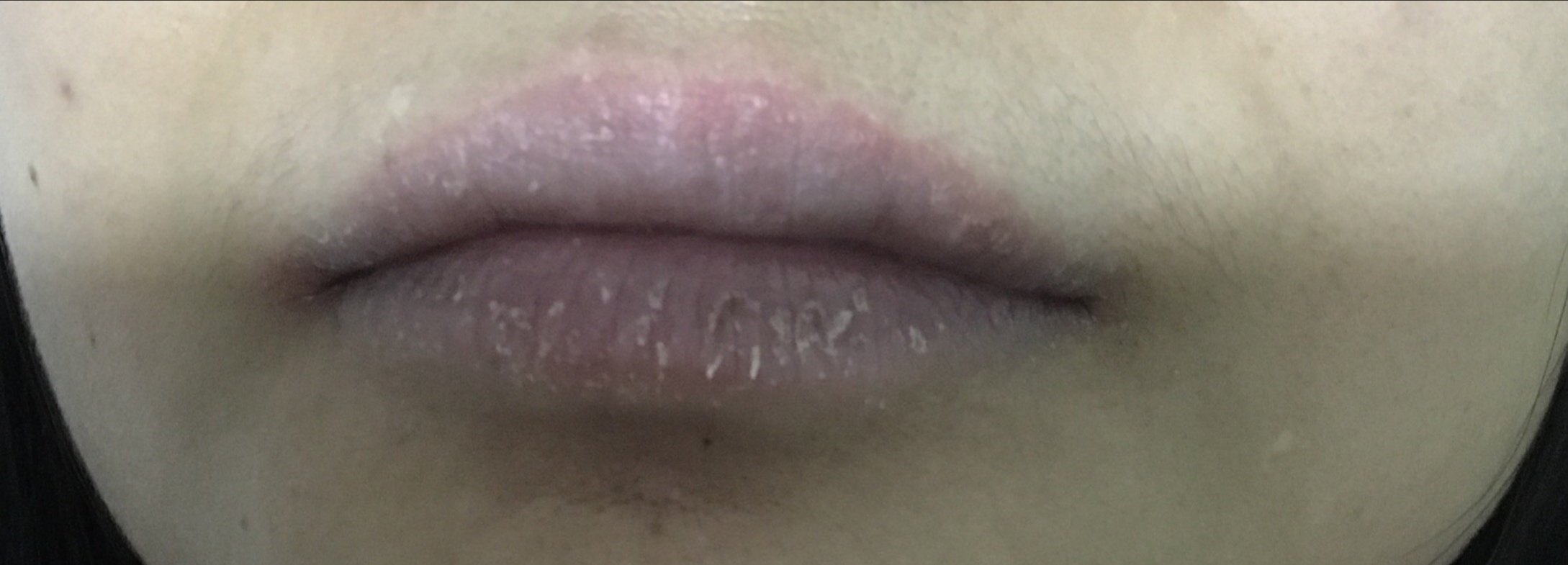 慢性唇炎是什么样子