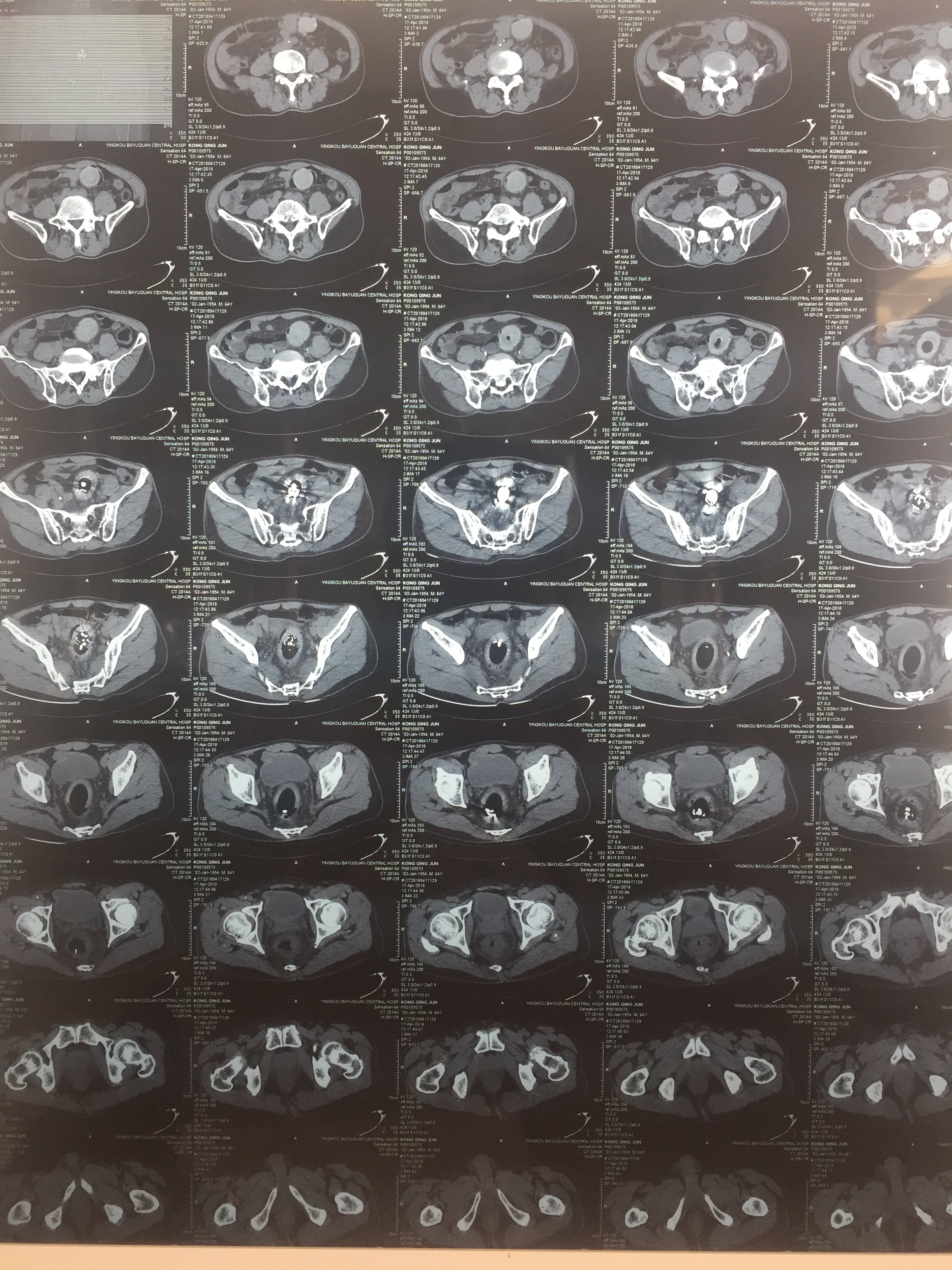 直肠异物 低位肠梗阻 - 好大夫在线