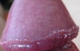 什么是阴茎珍珠疹