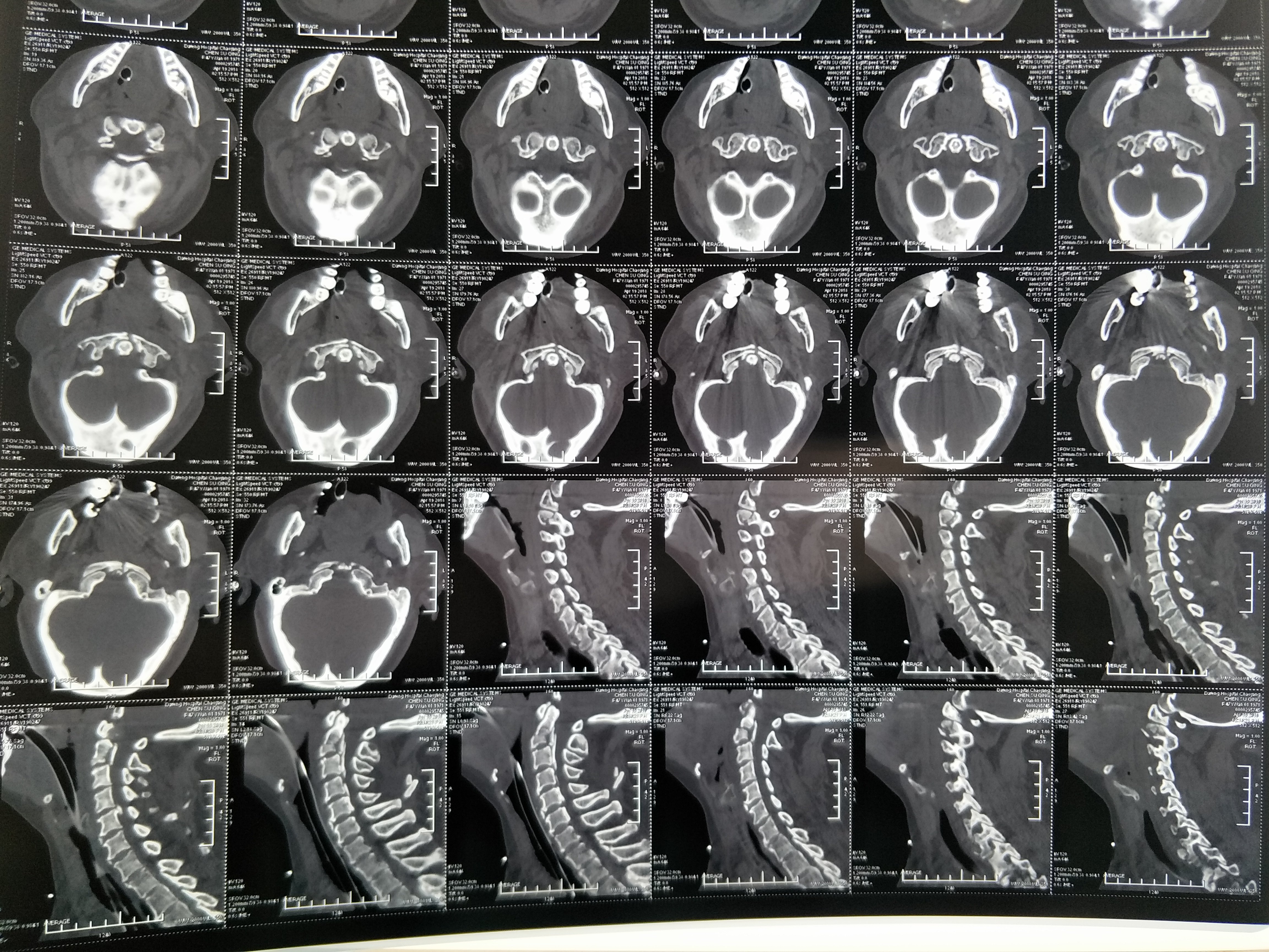颈椎x光片骨折图片