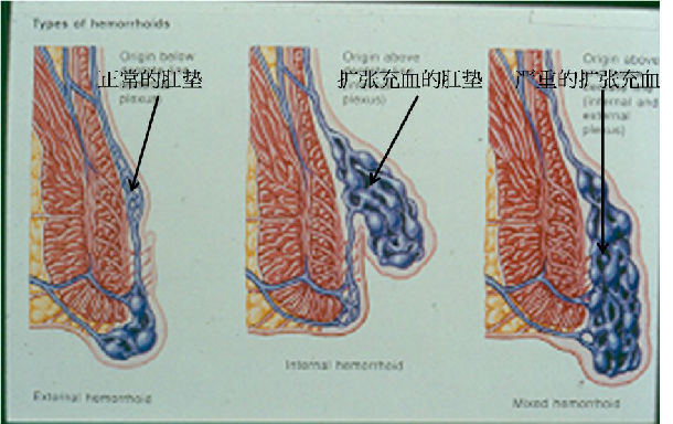 总结起来,肛垫反复充血扩张,肥厚,就会形成大的"血管团块",这就是"痔"