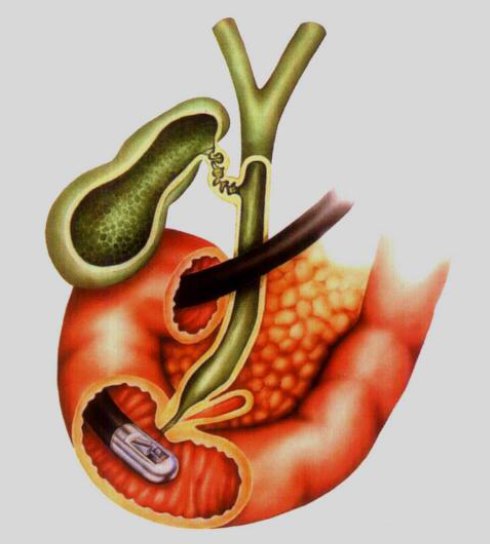 治疗性内镜逆行胰胆管造影术ercp