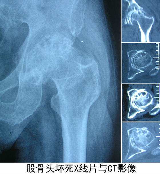 ④對可疑病例必須首先拍攝髖關節正位和蛙式位x線片,如無異常,應嚴密