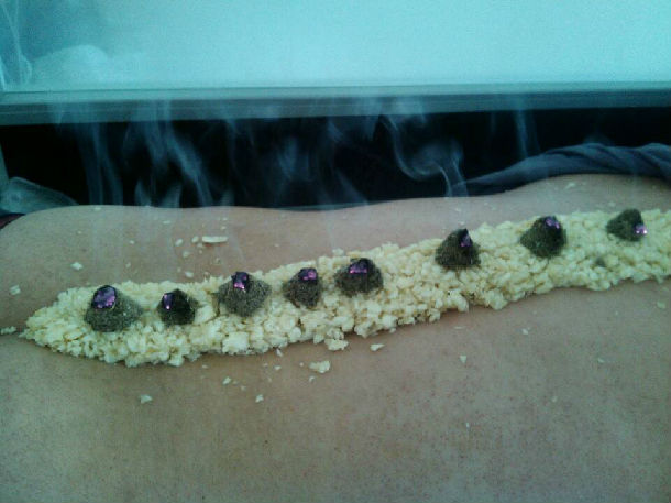 隔大蒜灸(长蛇灸)治疗强直性脊柱炎一例