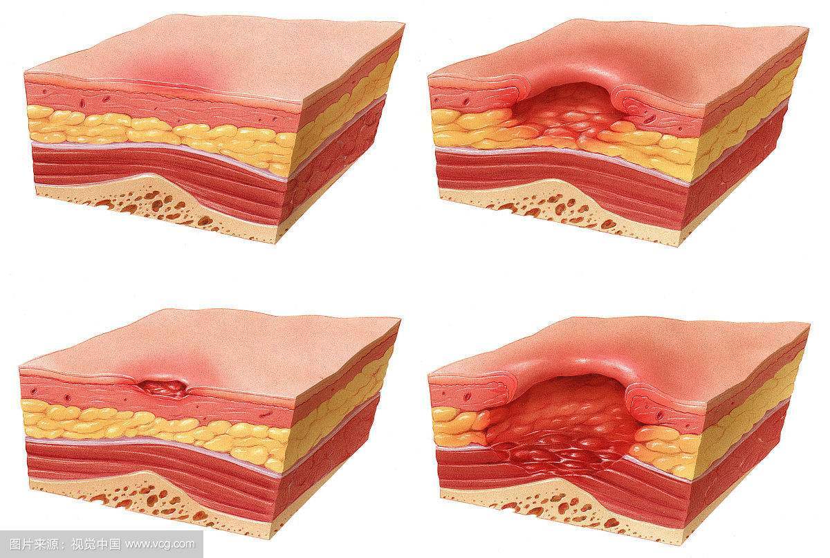 压疮的潜行和窦道图片图片