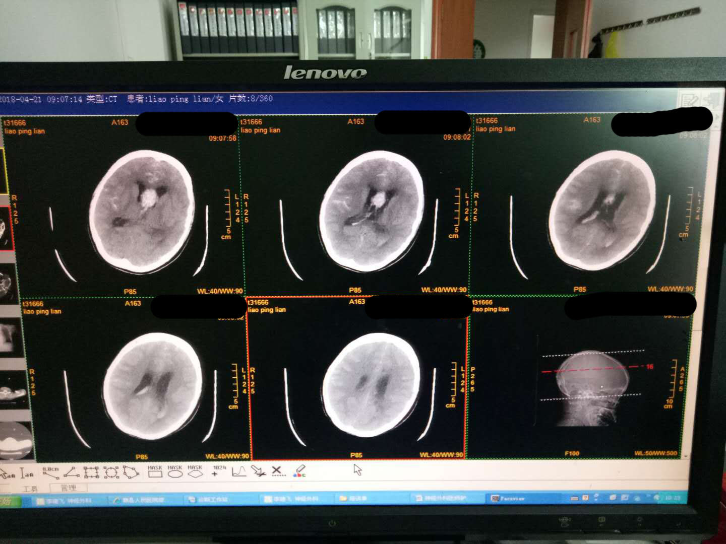 手术前,显示双侧脑室扩大, 并且室间孔处有血肿形成,梗阻性脑积水