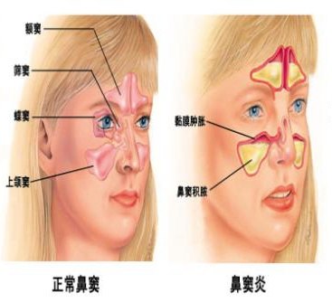 鼻窦炎图解图片