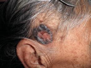 头皮紫色素瘤早期图片图片