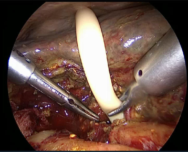 术后诊断:1,坏疽性,结石性胆囊炎,胆囊积脓.
