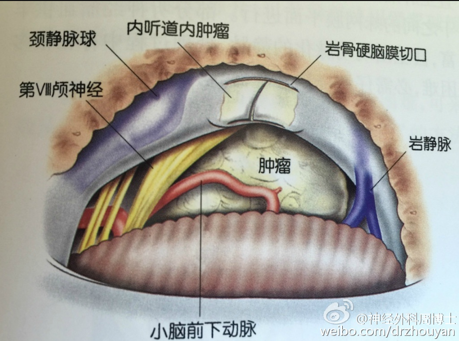 显露内听道内口后"h"型切开内听道后方的硬脑膜,外侧距离内耳孔不