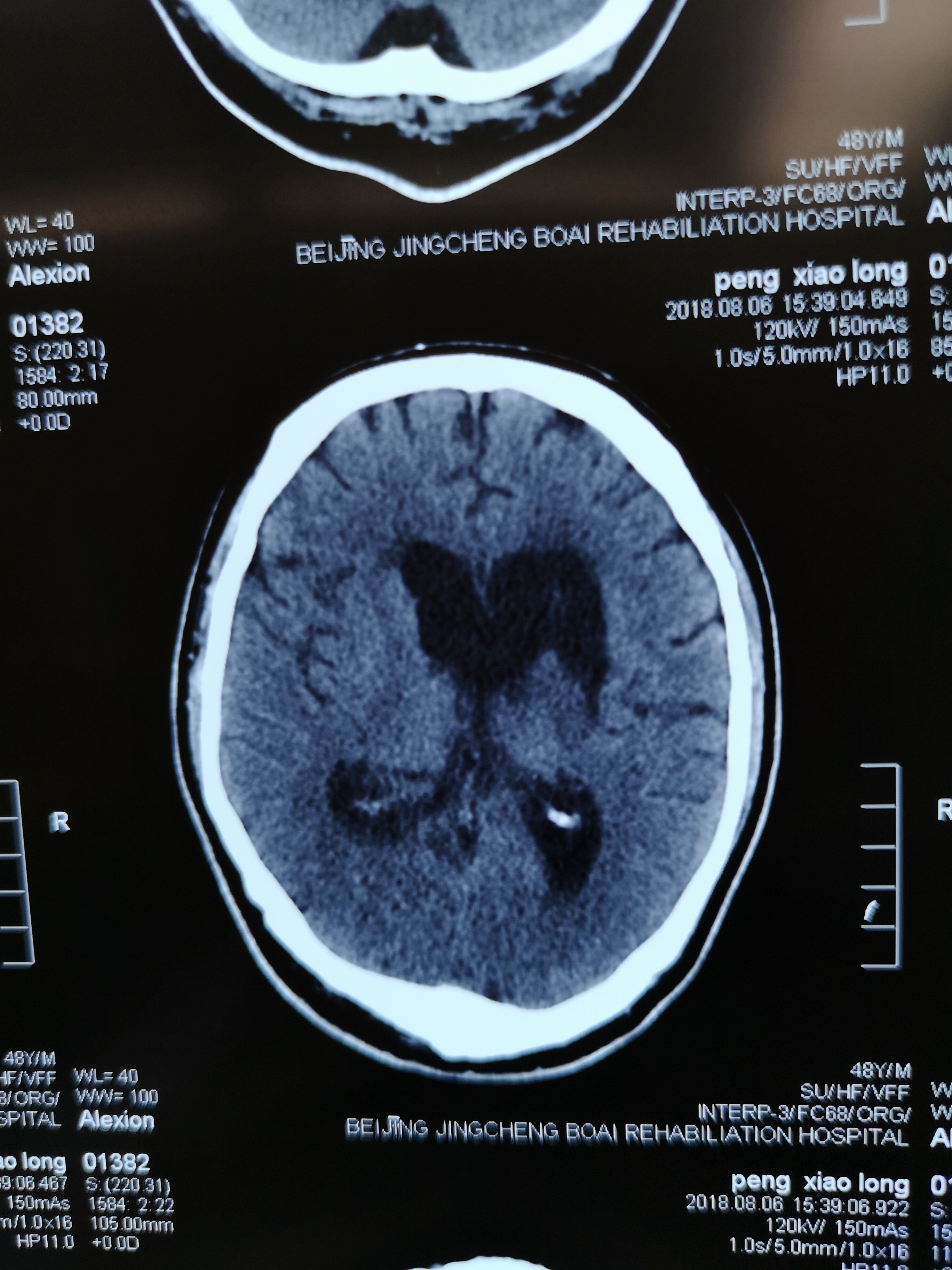 醒7-左侧脑出血破入脑室后清醒,再度脑干出血陷入昏迷不醒 - 好大夫