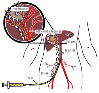 肝癌介入治疗操作简单易行,安全可靠,不须全麻,可以重复进行,而且肝癌
