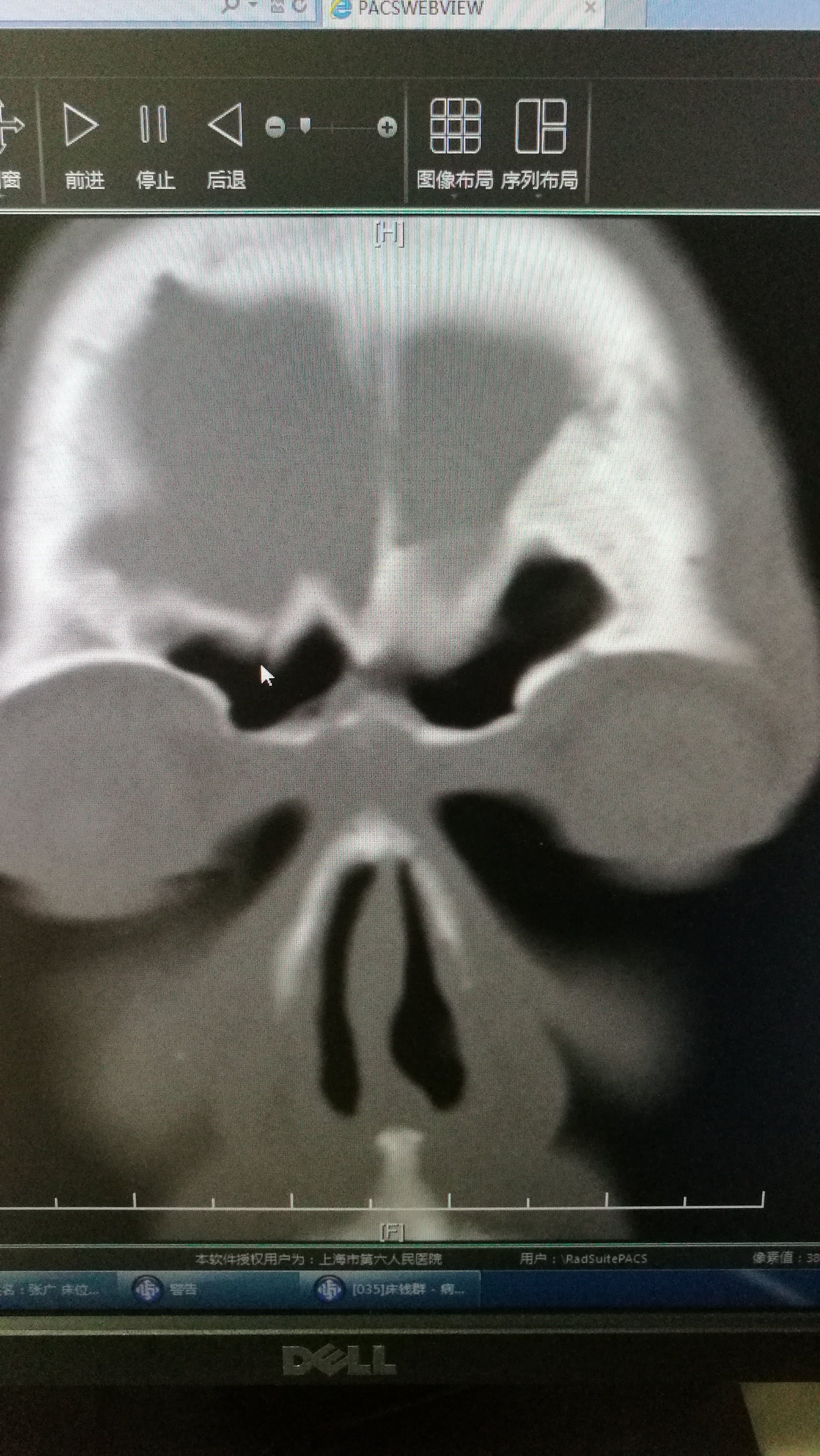 脊髓液鼻漏图片
