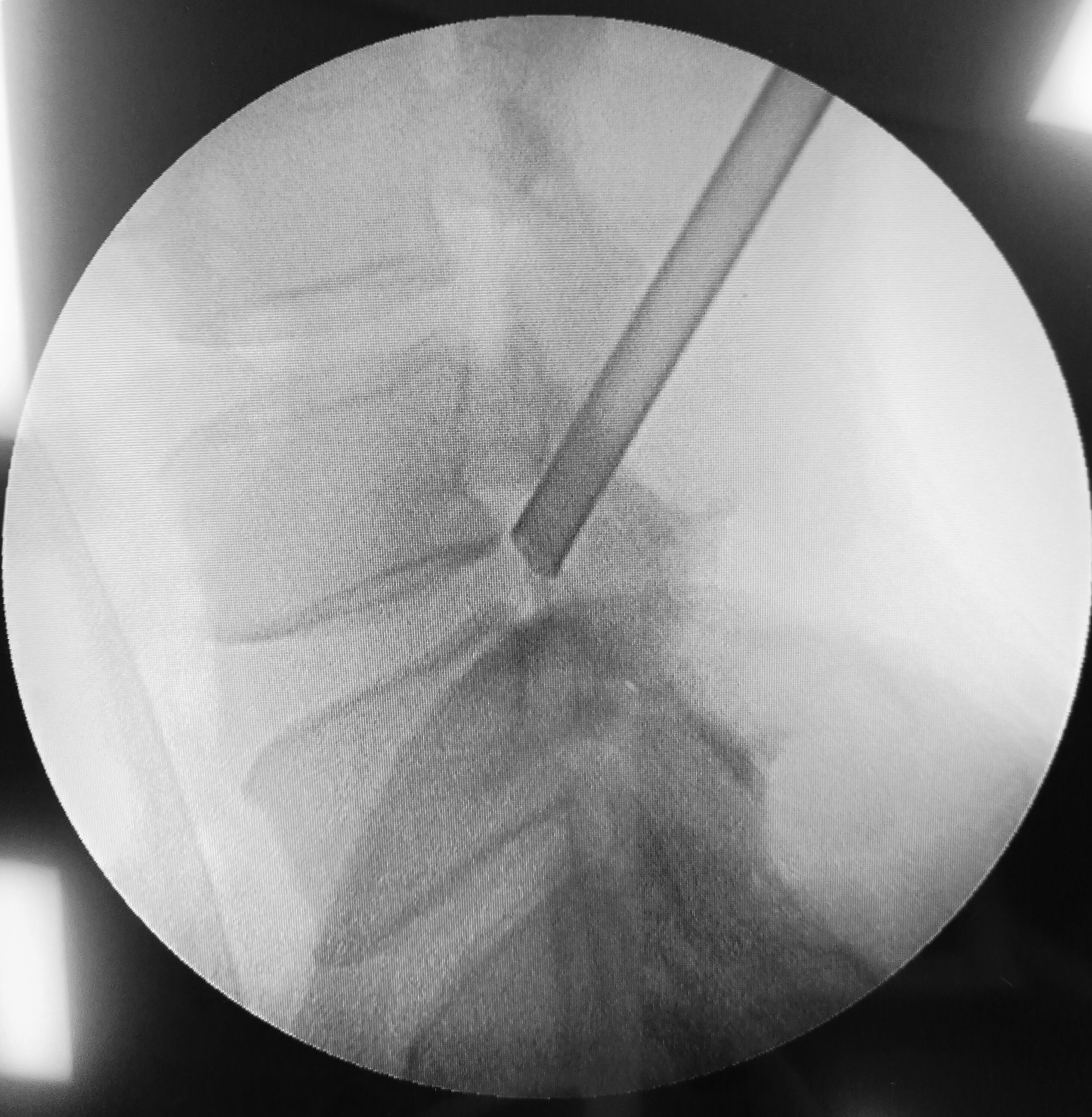 椎间孔镜的优势 - 好大夫在线