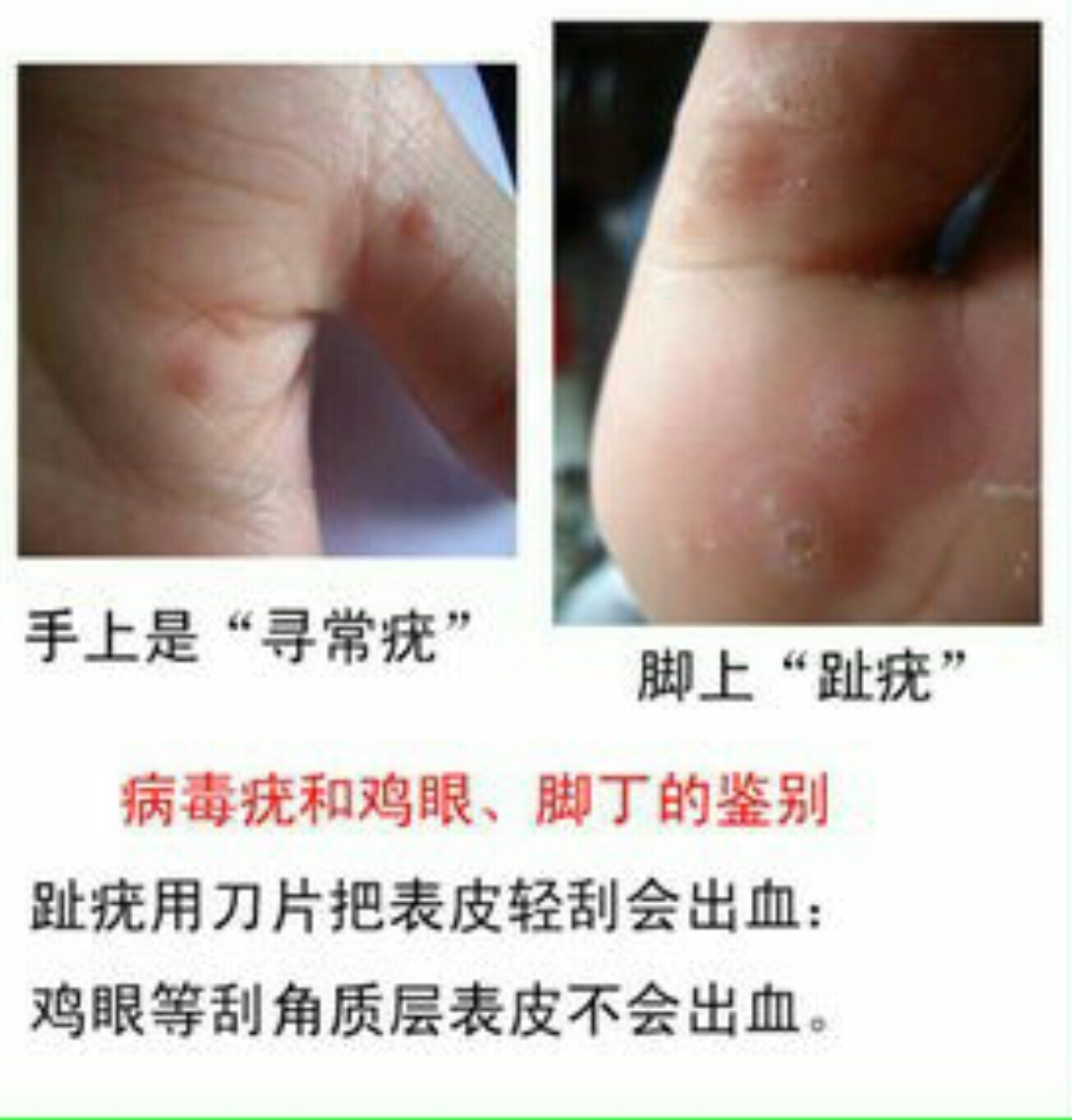 疣和瘊子的图片,疣和瘊子的区别图片,瘊子图片_大山谷图库