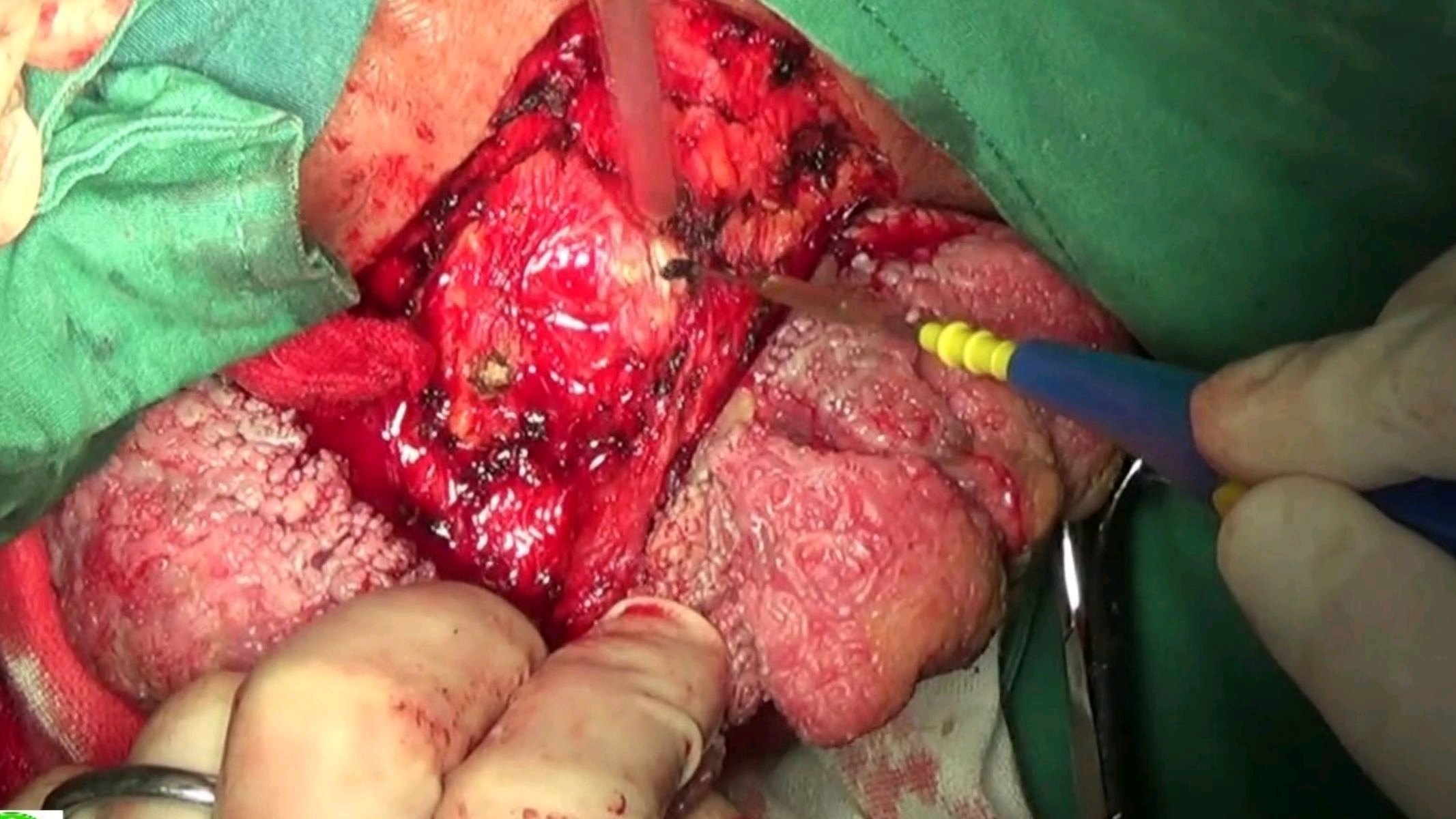 肛周长出巨大"菜花"?普外专家妙手"摘花"——市中心医院 - 好大夫在线