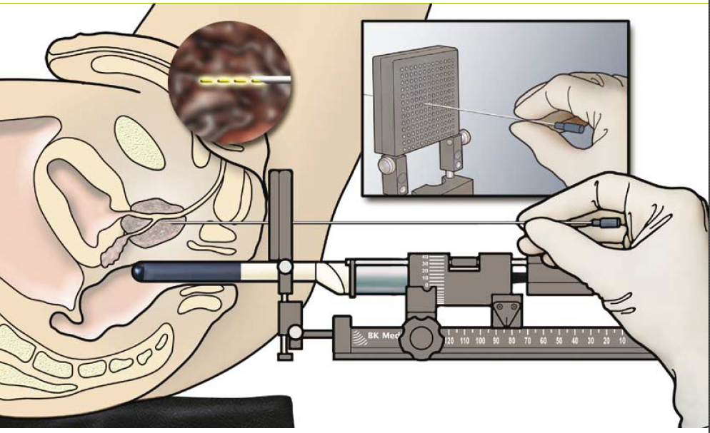 前列腺癌放射性粒子植入治疗(内放疗)效果如何 - 好大夫在线