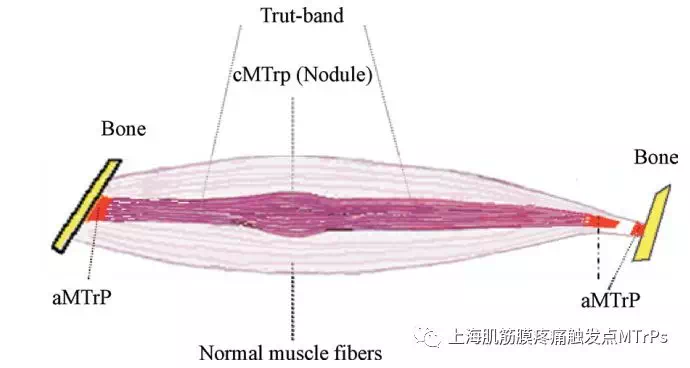 肌筋膜触发点技术自我治疗女性痛经