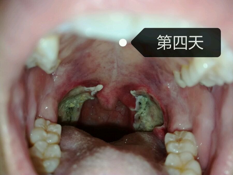 腺样体扁桃体切除术后注意事项 小儿腺样体肥大 日常护理 饮食运动 好大夫在线 腺样体扁桃体切除术后注意事项 小儿腺样体肥大 日常护理 饮食运动 好大夫在线