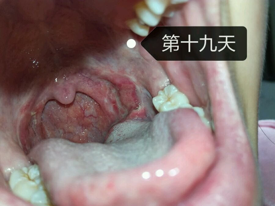 腺样体扁桃体切除术后注意事项 小儿腺样体肥大 日常护理 饮食运动 好大夫在线 腺样体扁桃体切除术后注意事项 小儿腺样体肥大 日常护理 饮食运动 好大夫在线