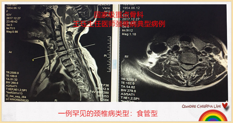 食管压迫型颈椎病图片图片