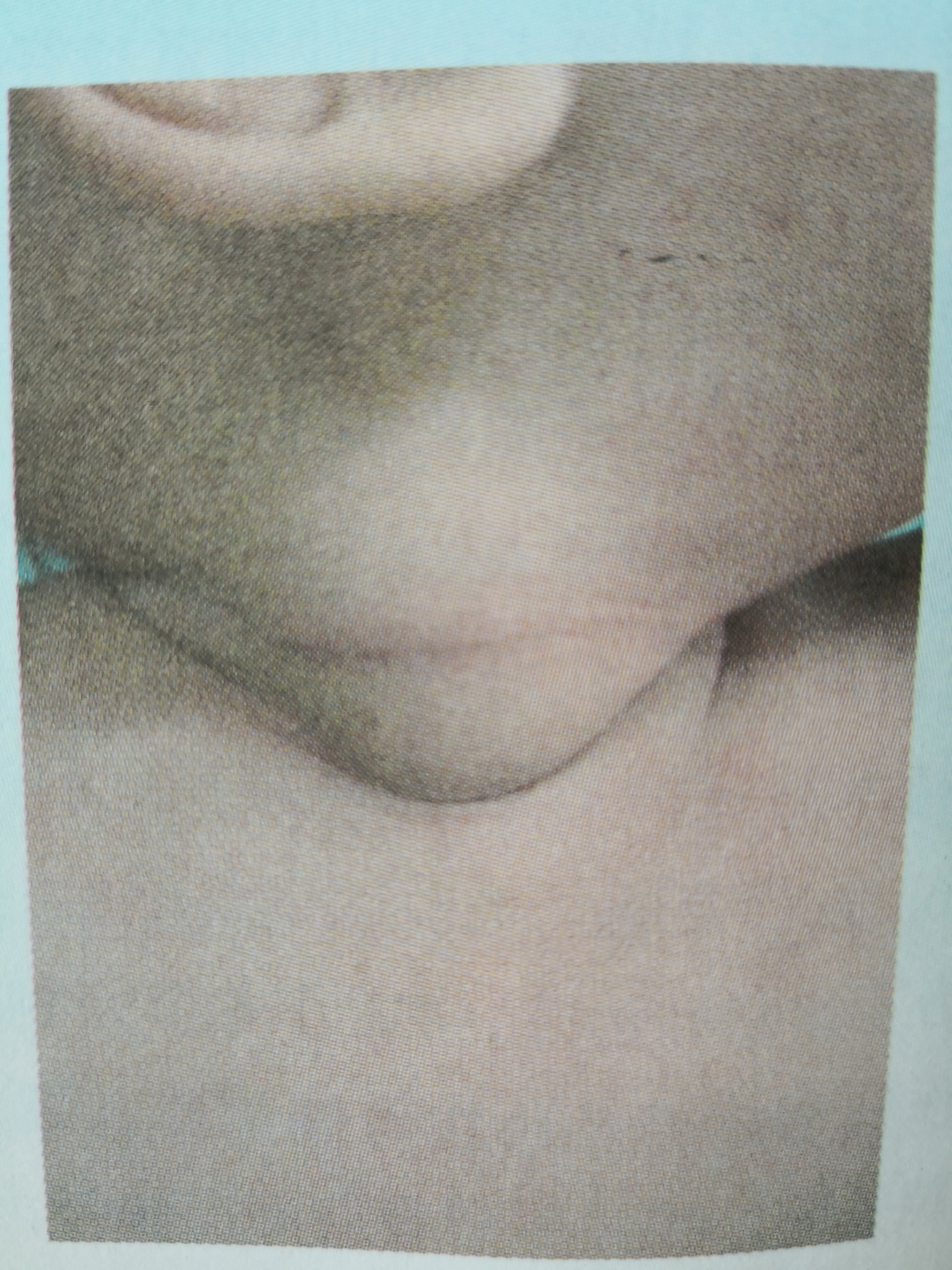 孩子脖子一侧发现包块,小儿斜颈是怎么回事?