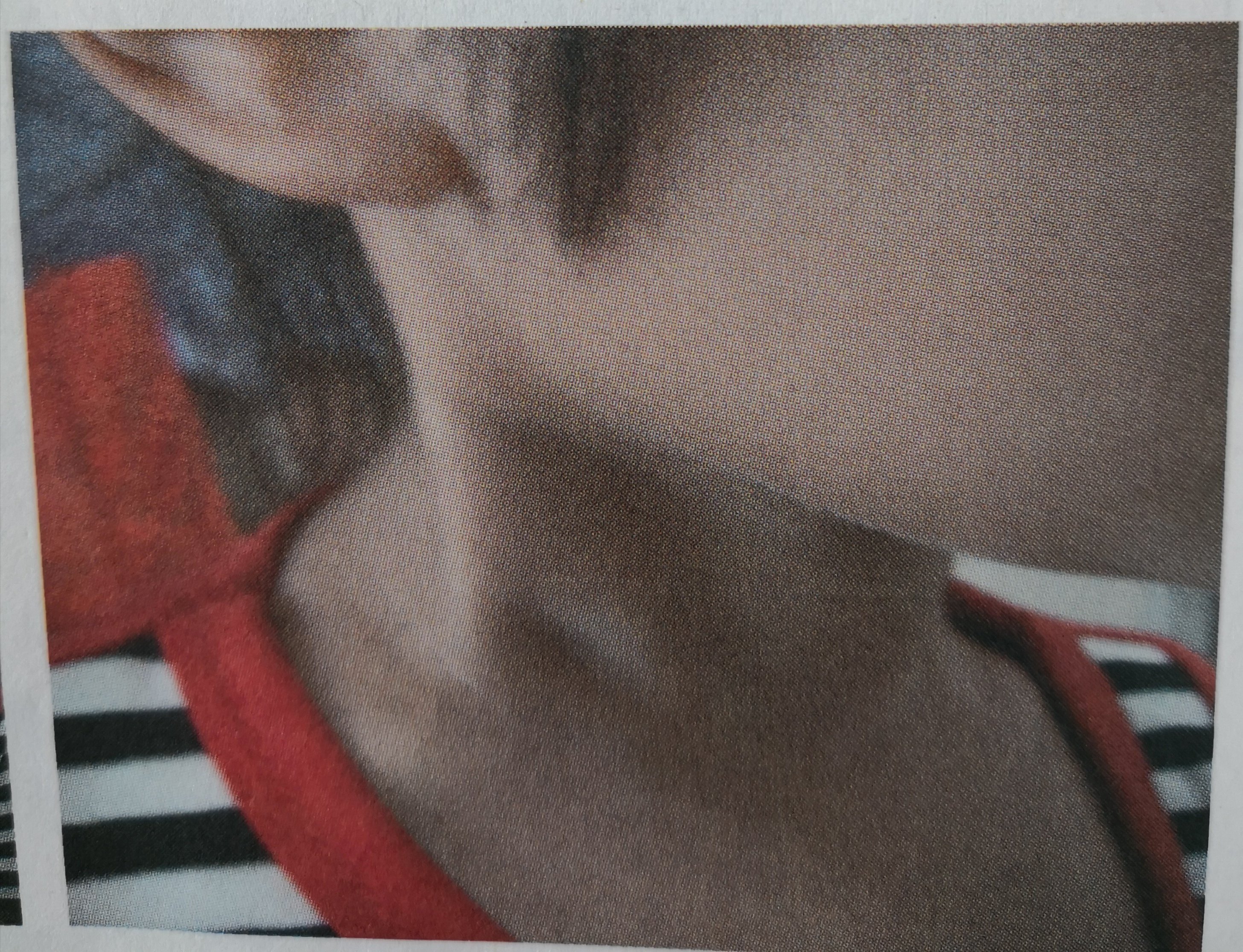 孩子脖子一侧发现包块,小儿斜颈是怎么回事?