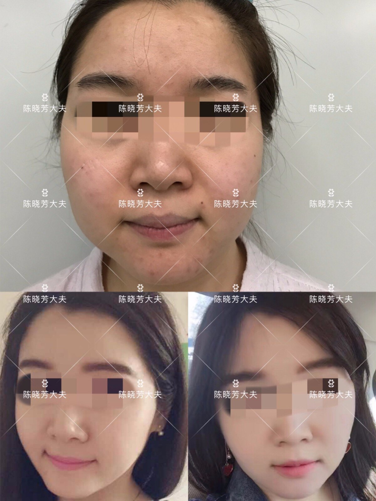 面部吸脂手术案例——面部注射溶脂针能瘦脸吗? 