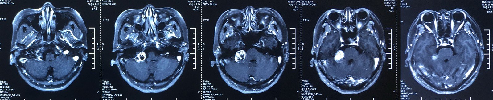 开心的笑容--大型听神经瘤(3期)手术痊愈出院