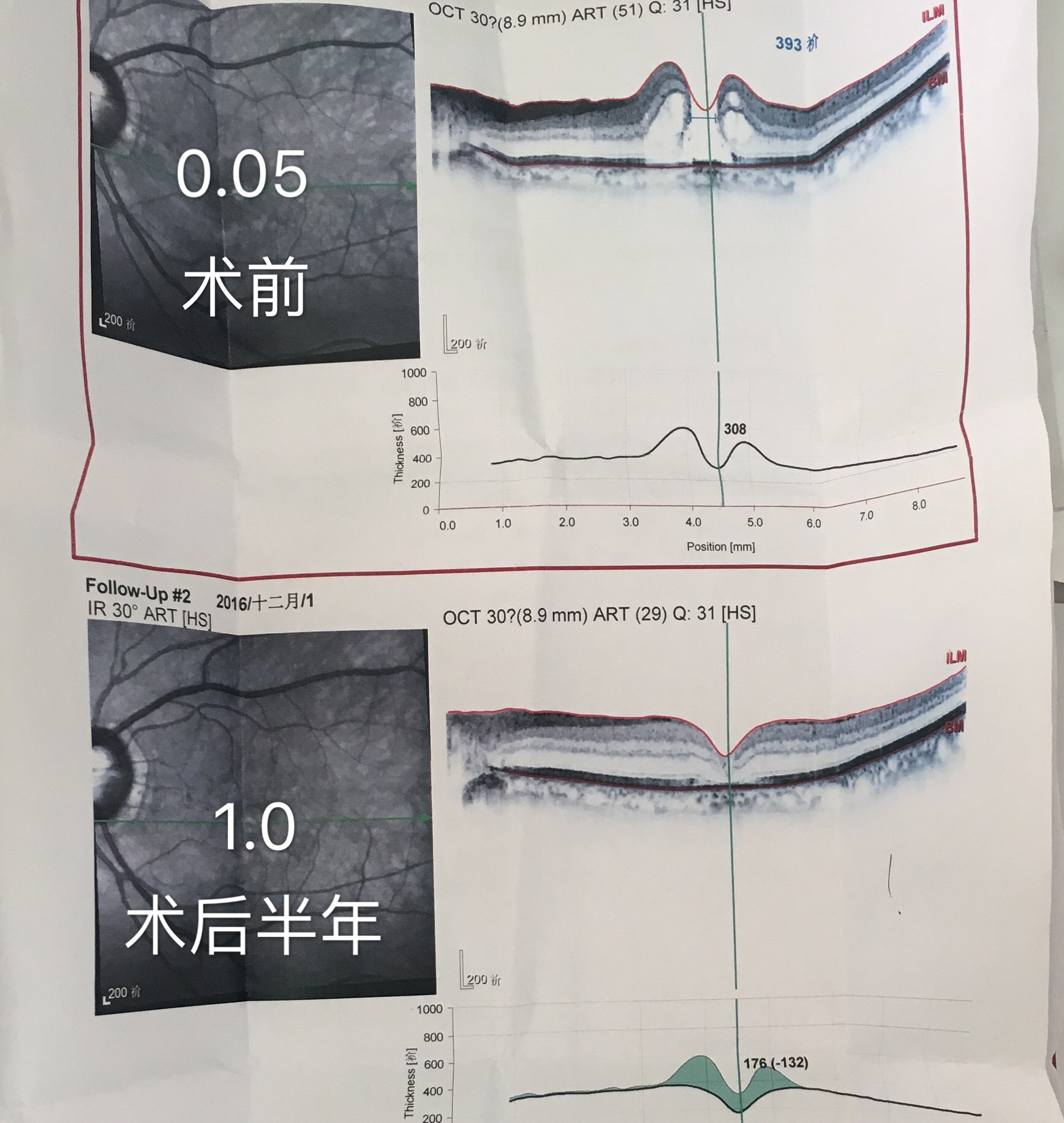 巨大黃斑裂孔不放棄,早期黃斑孔早治療!