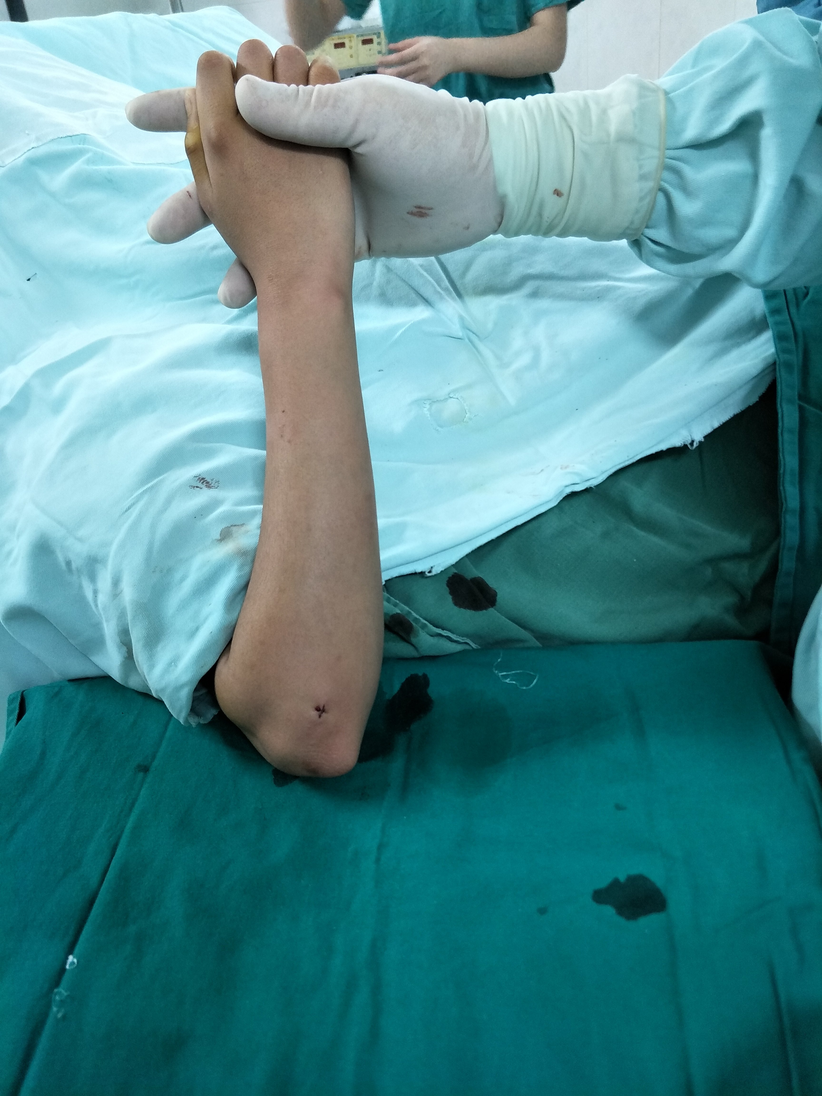 儿童桡骨远端骨折手术图片