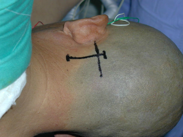面肌痉挛手术微创图片图片