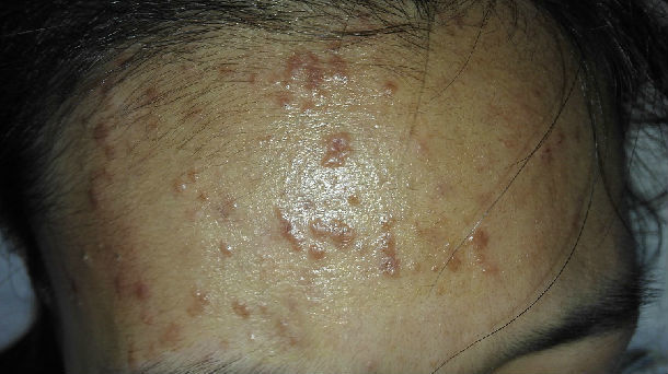 扁平疣的中医火针治疗