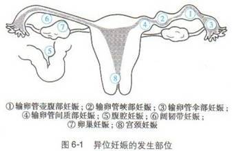 有一种宫外孕叫 纠结型宫外孕 宫外孕 疾病介绍