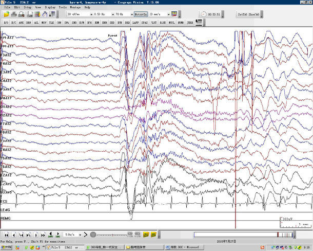 小孩突然跌倒后抽搐是什么病?