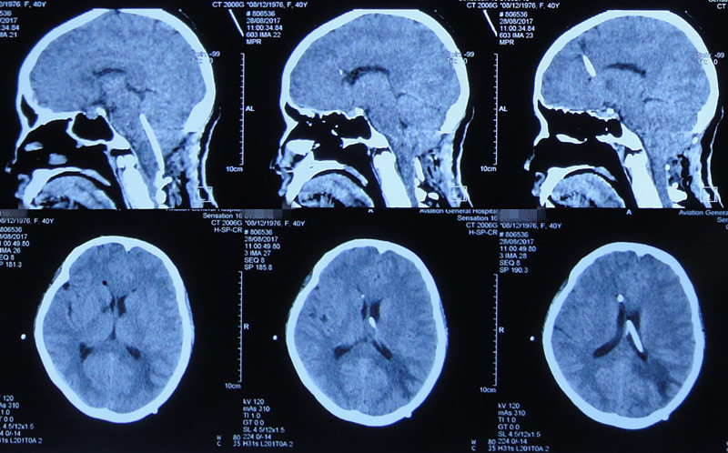 腦脊液科挽救小腦扁桃體下疝畸形減壓術後的早期腦幹周感染 - 好大夫