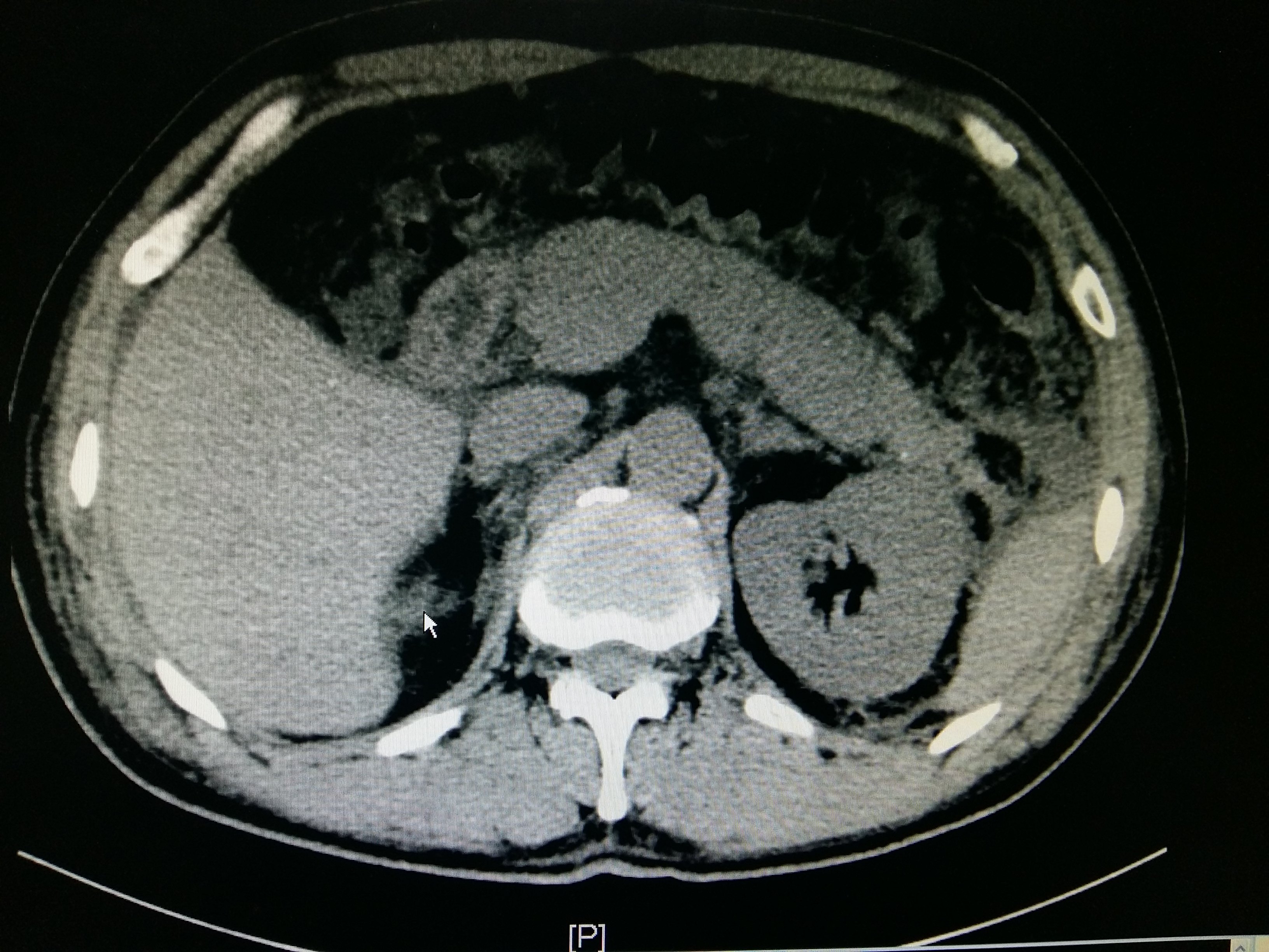 环状胰腺ct表现图片