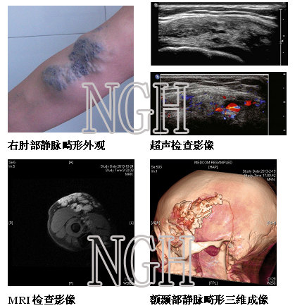 體表軟組織靜脈畸形海綿狀血管瘤