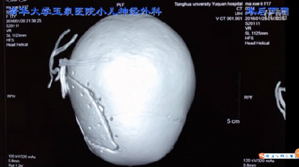 我們根據大量臨床病例實踐,總結出《清華大學顱骨修補手術方案》,患者