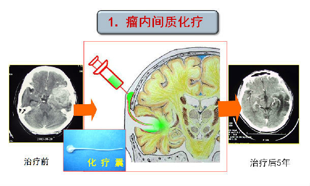 颠覆神经胶质瘤传统综合治疗的临床新技术(一)