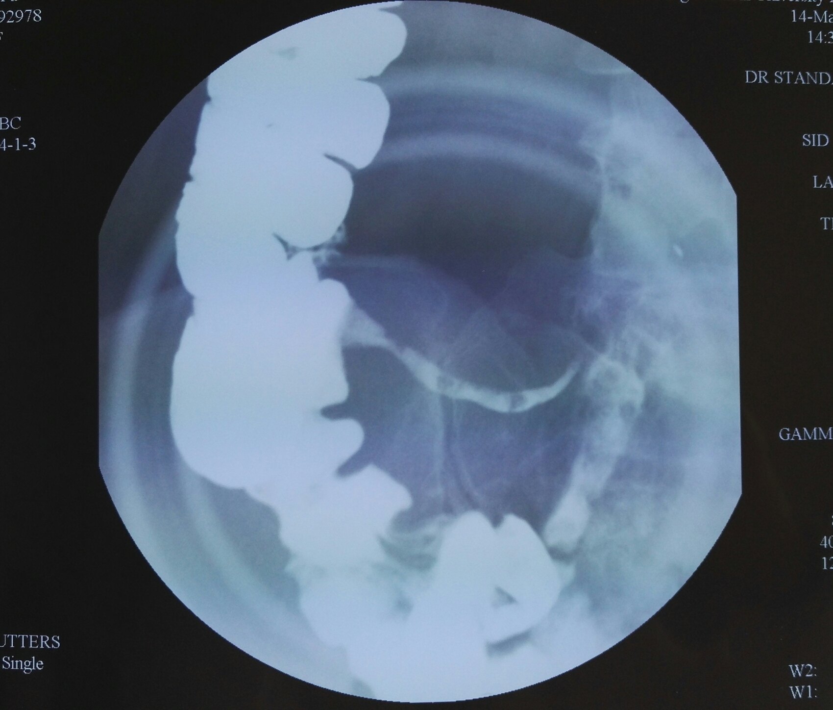 图5-6 牛角型胃(X线钡餐造影)-外科学-医学