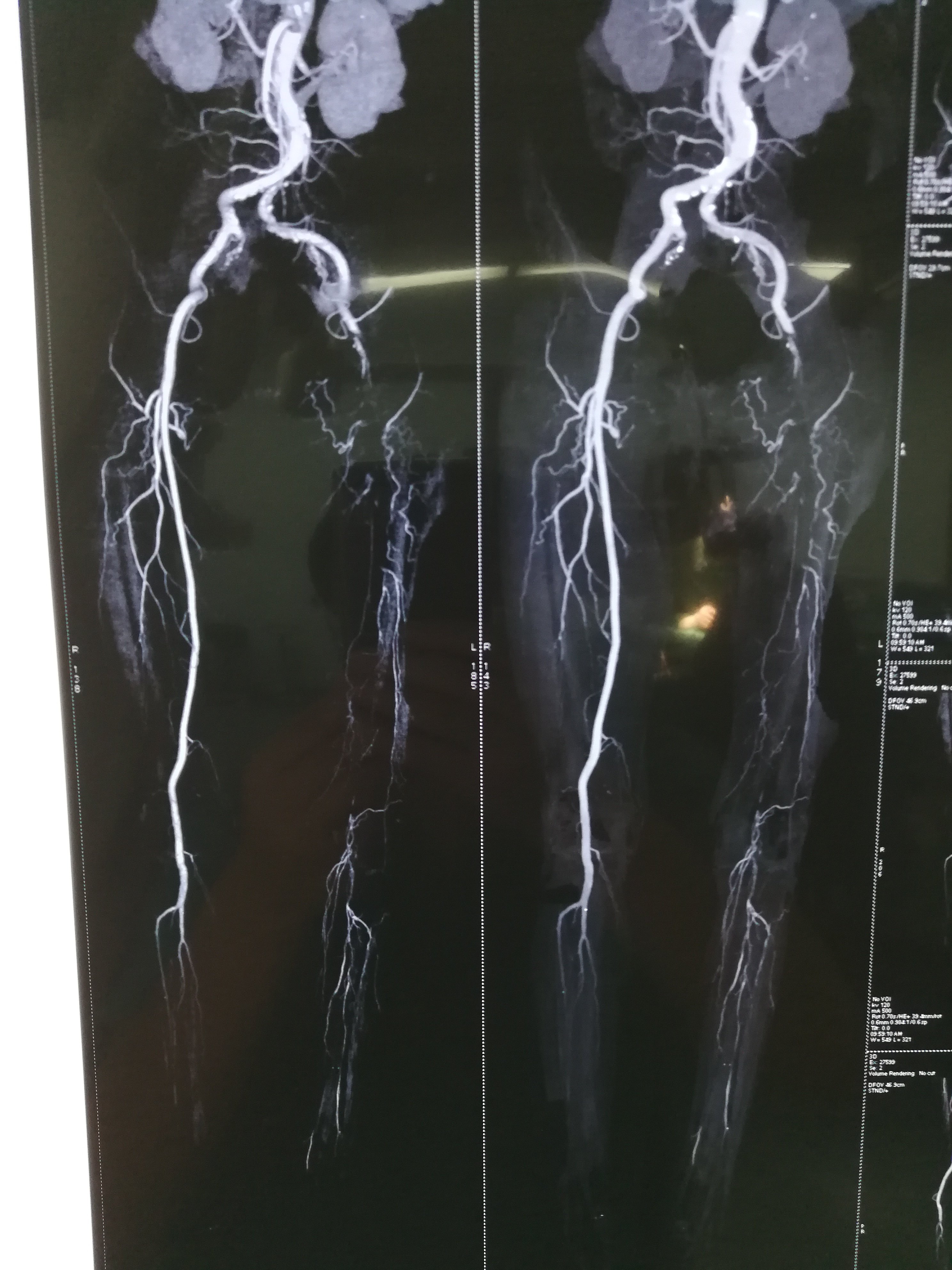 左侧髂股腘动脉栓塞,肢体频临坏死急诊手术,取出的血栓房颤是目前国人