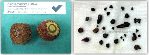 一文读懂"胆结石"—胆结石防治最新理念