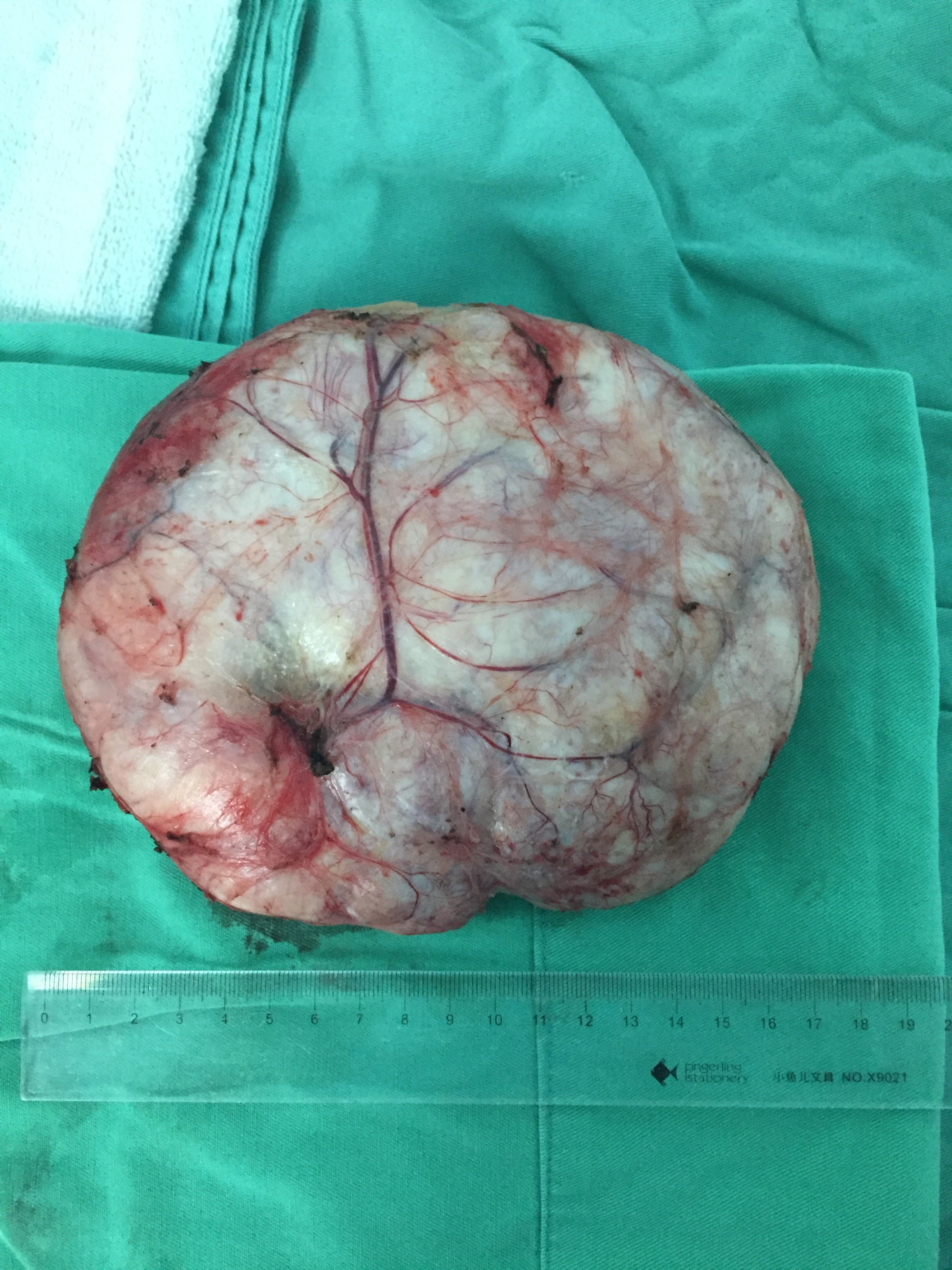 叶状囊肉瘤图片